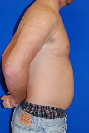 Liposuction Case 4871- creation of 6 pack abs with liposuction Before Photo Liposuction