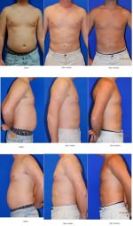 Liposuction