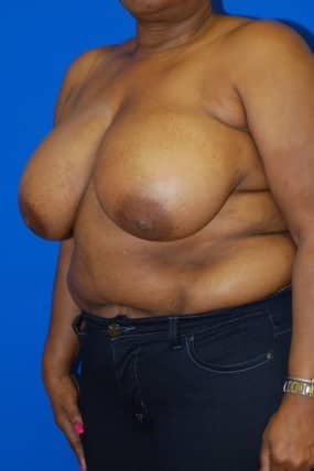 Breast Reduction