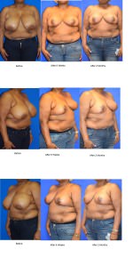 Breast Reduction