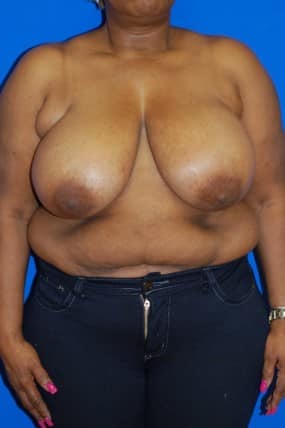 Breast Reduction