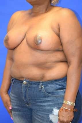 Breast Reduction