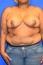 Breast Reduction