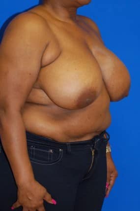 Breast Reduction