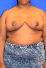 Breast Reduction