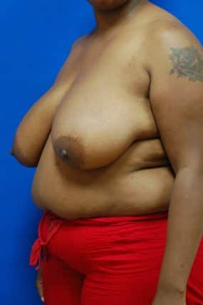 Breast Reduction