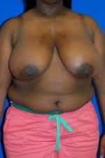 Breast Reduction