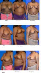 Breast Reduction