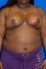 Breast Reduction