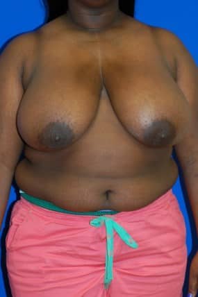 Breast Reduction