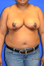 Breast Reduction