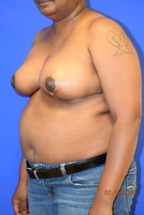 Breast Reduction