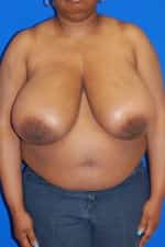 Breast Reduction