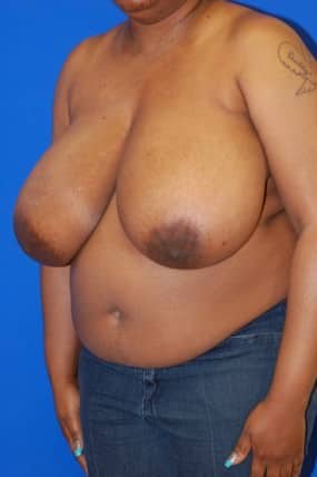Breast Reduction