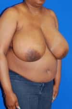 Breast Reduction
