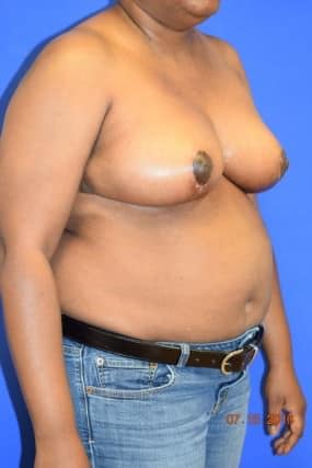 Breast Reduction