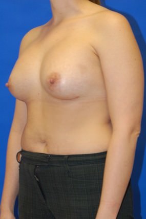 Breast Augmentation