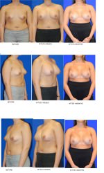 Breast Augmentation