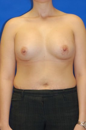 Breast Augmentation