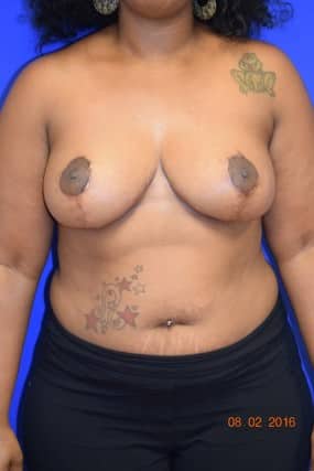 Breast Reduction