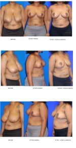 Breast Reduction
