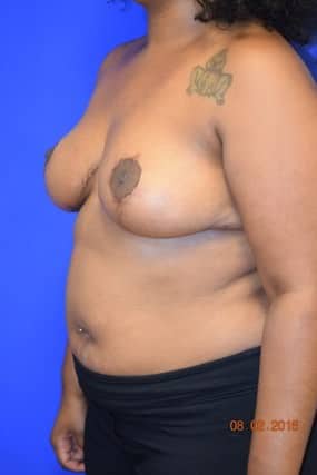 Breast Reduction