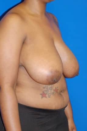 Breast Reduction