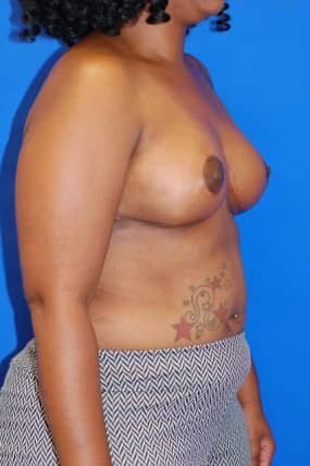 Breast Reduction
