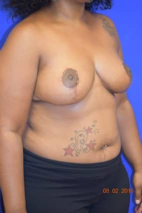 Breast Reduction