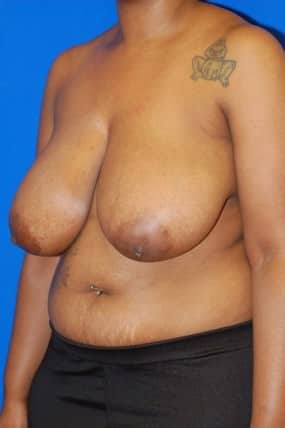 Breast Reduction