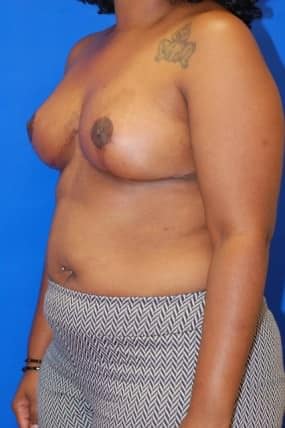 Breast Reduction