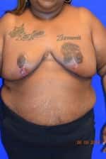 Breast Reduction