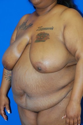 Breast Reduction