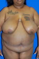 Breast Reduction
