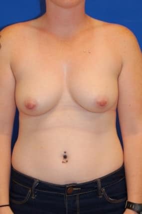 Breast Augmentation