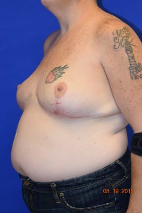 Breast Reduction