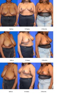 Breast Reduction
