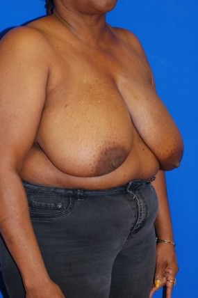 Breast Reduction