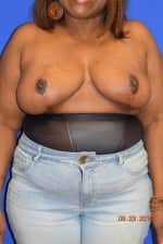 Breast Reduction