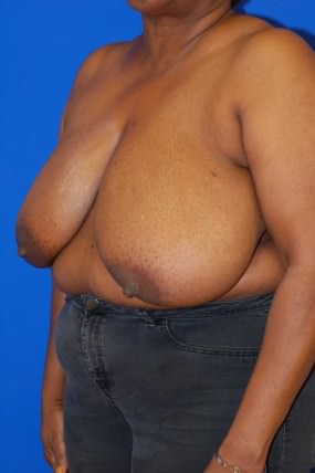 Breast Reduction