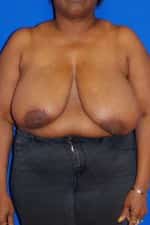 Breast Reduction