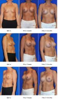 Breast Augmentation