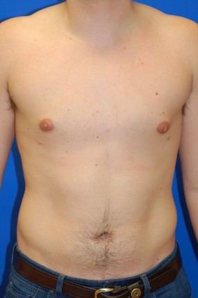 Male Breast Reduction
