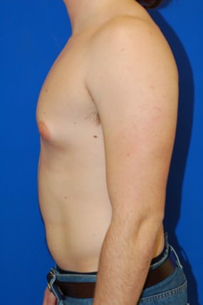 Male Breast Reduction
