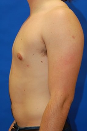 Male Breast Reduction