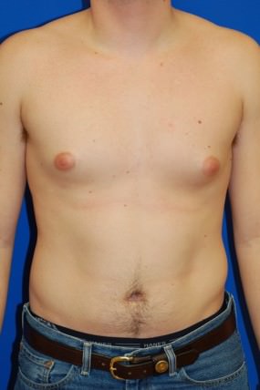 Male Breast Reduction