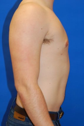 Male Breast Reduction