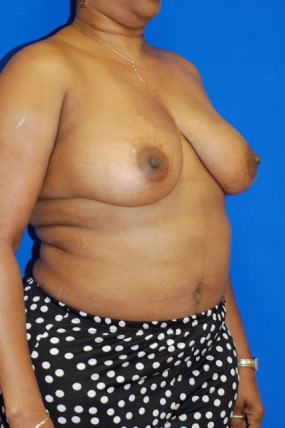 Breast Reduction