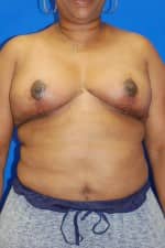 Breast Reduction