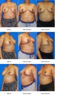 Breast Reduction